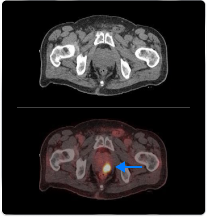 PET scan image of a prostate/PET scan image of prostate pointing out bilateral ureters