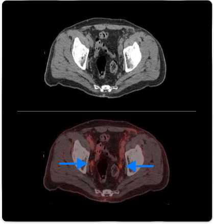 PET scan image of a prostate/PET scan image of a prostate pointing out the primary malignancy