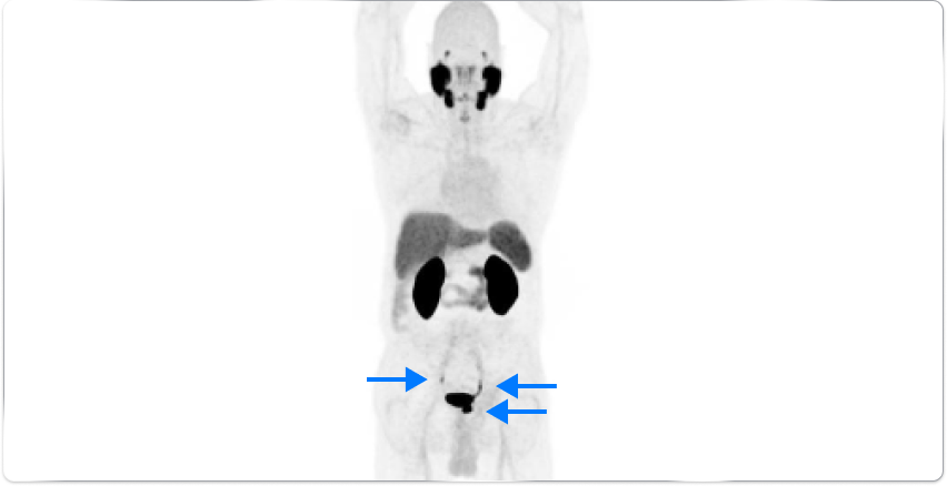  PET scan image of lungs and prostate in a male body