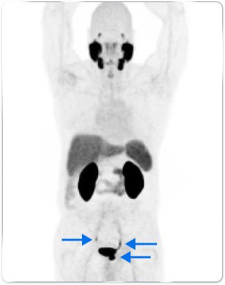  PET scan image of lungs and prostate in a male body