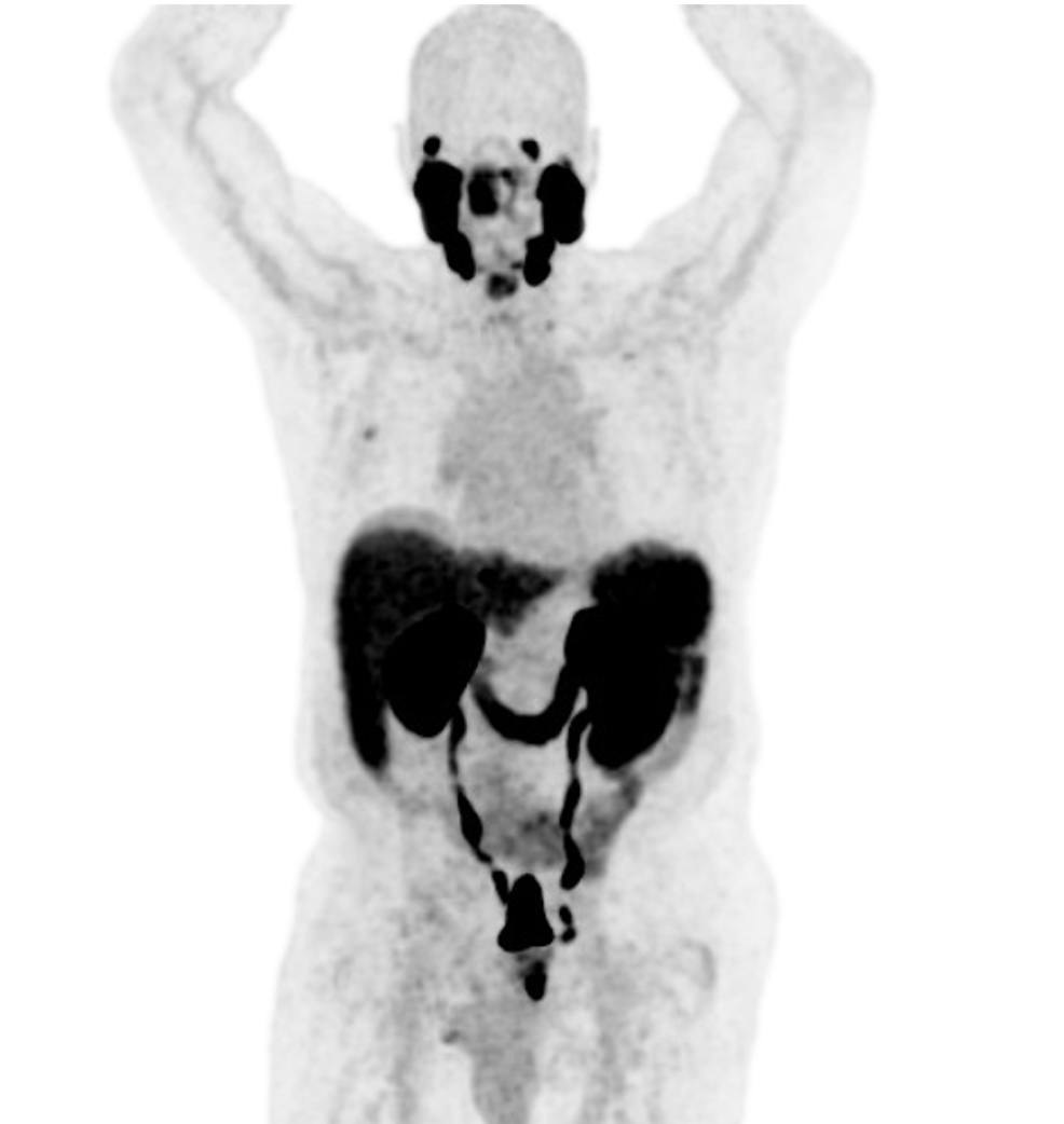 Image of PYLARIFY scan