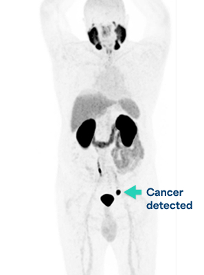 PSMA PET scan with PYLARIFY Example of a PSMA PET scan with PYLARIFY and what a doctor may see