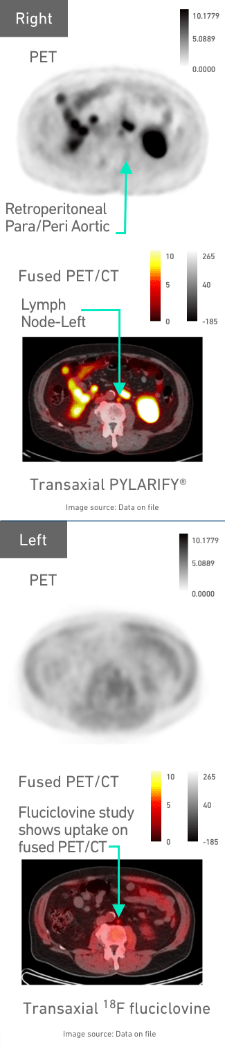 PYLARIFY® PET scan revealing that a 71-year-old patient had left common iliac lesions and multiple lymph node lesions