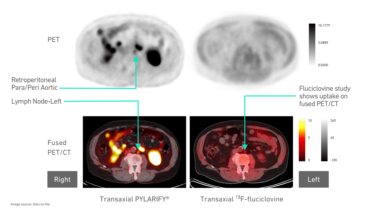 PYLARIFY® PET scan revealing that a 71-year-old patient had left common iliac lesions and multiple lymph node lesions